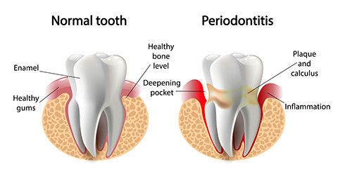 periodontal gum disease santa ana