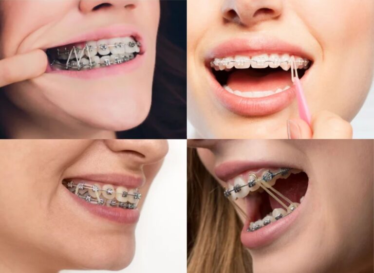 What Do Rubber Bands Do on Braces? OC Dental Center