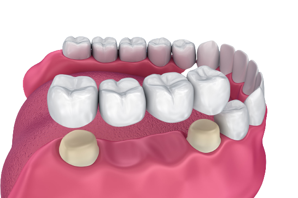 Difference Between Bridge and Implant - OC Dental Center