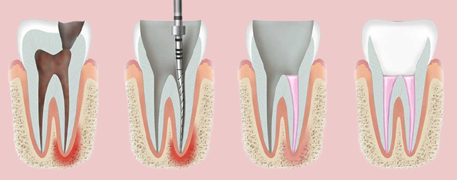 root canal process graphic illustration