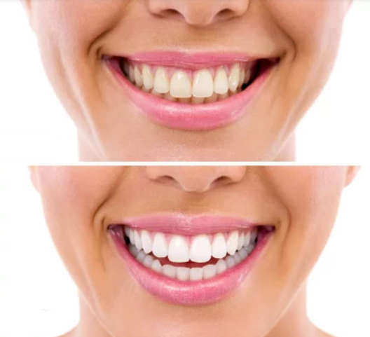 closeup of personćs smile before and after