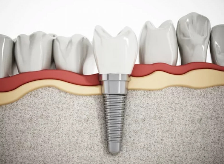 dental implant work system