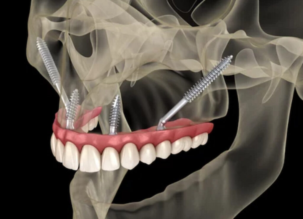 Zygomatic Dental Implants System Illustration