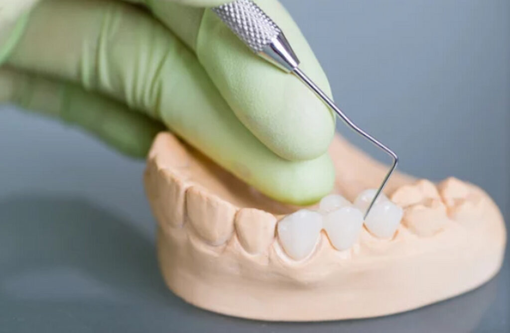 dental bridge on the teeth model