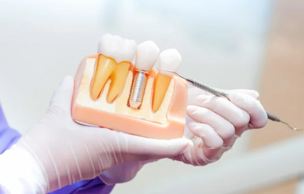 a dentist holding teeth model with an implant