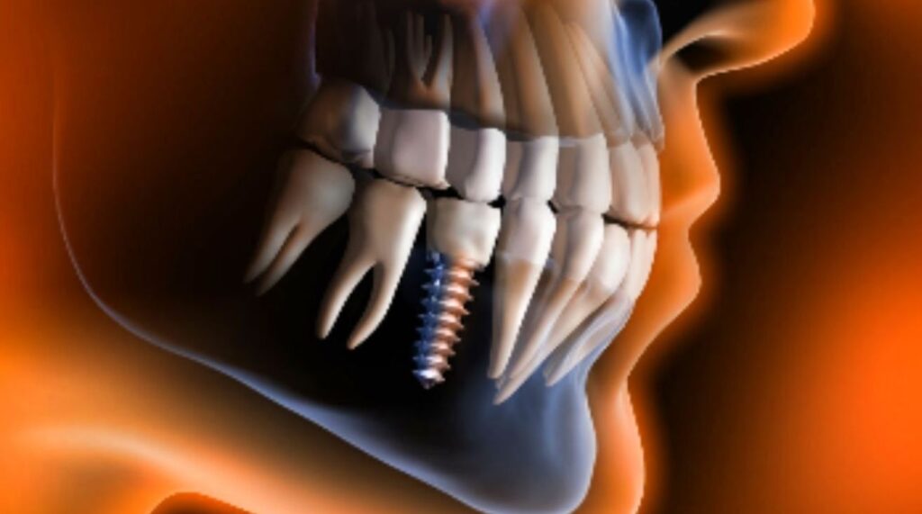 teeth with a dental implant graphic illustration