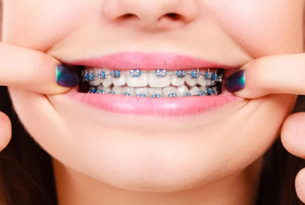 closeup of person's teeth with braces