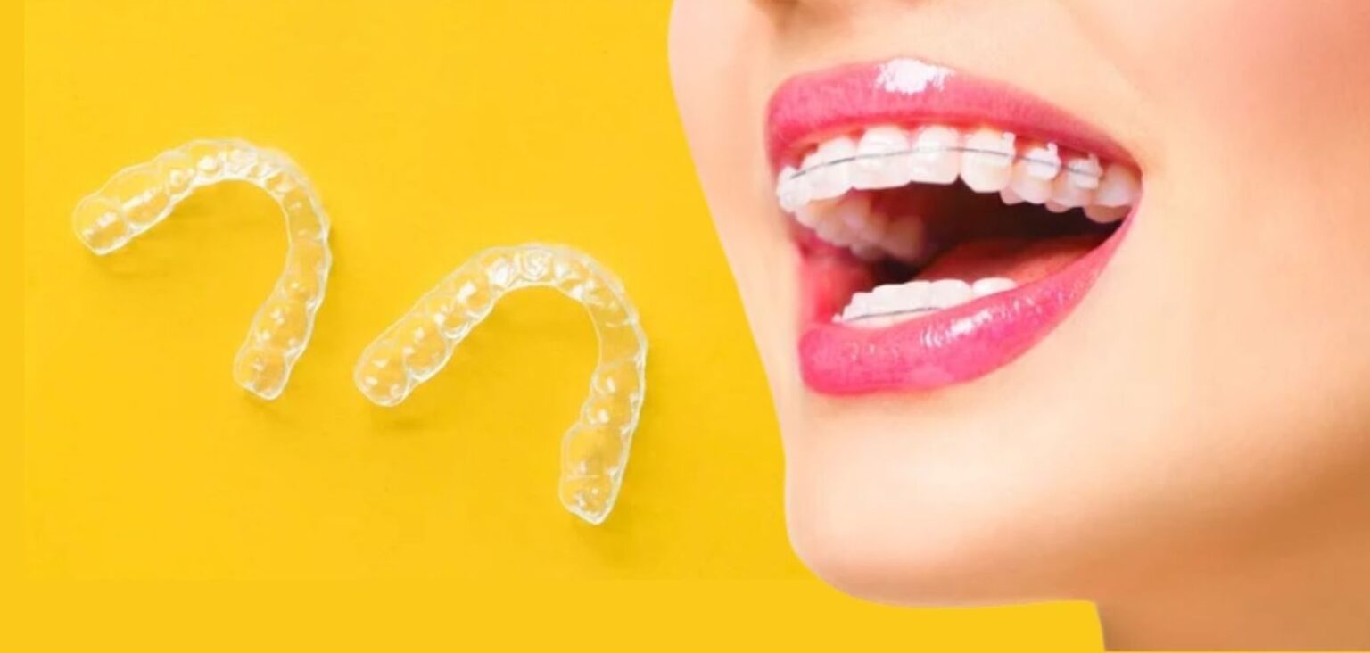 Is Invisalign Cheaper Than Braces? OC Dental Center