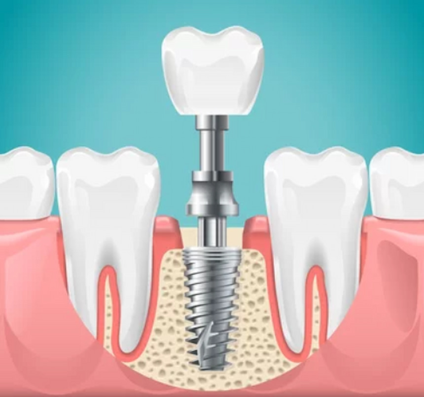 dental implant graphic illustration