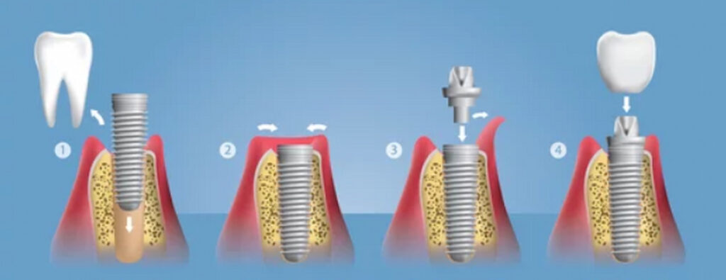 graphic illustration of dental implants