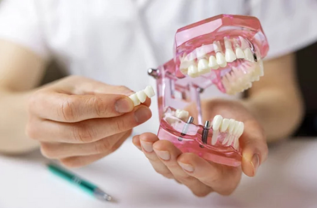 teeth model with dental implants in a person's hands