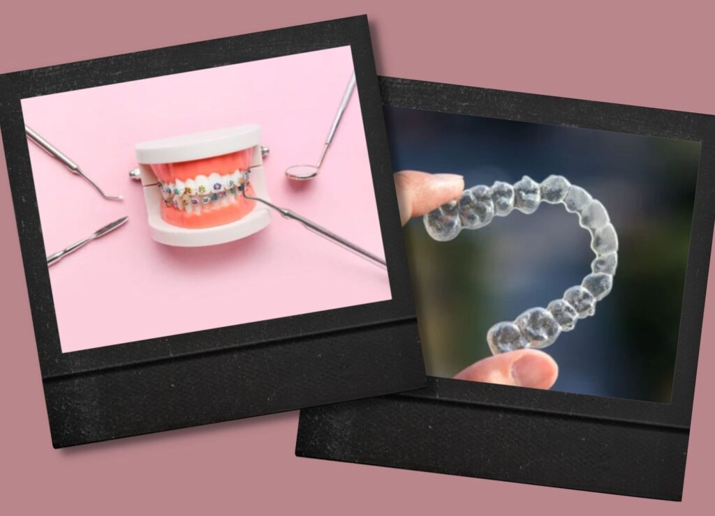 Is Invisalign Cheaper Than Braces? OC Dental Center