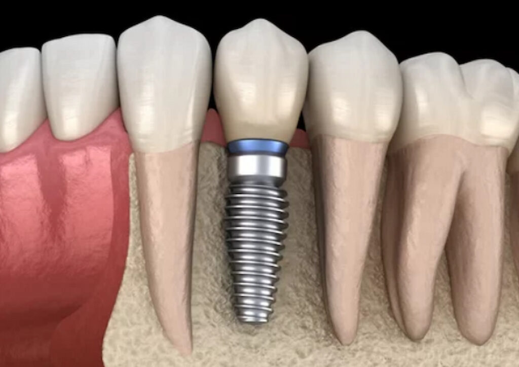 teeth model with an implant graphic illustration