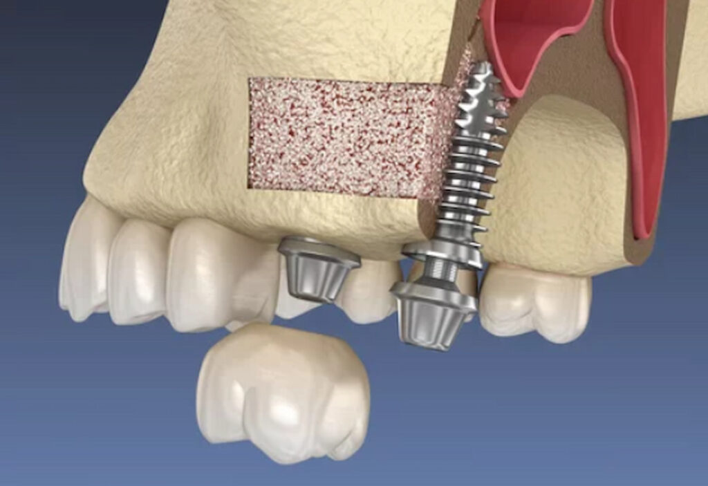 dental implants in upper jaw