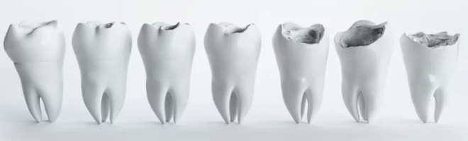 cavity process presented on tooth models