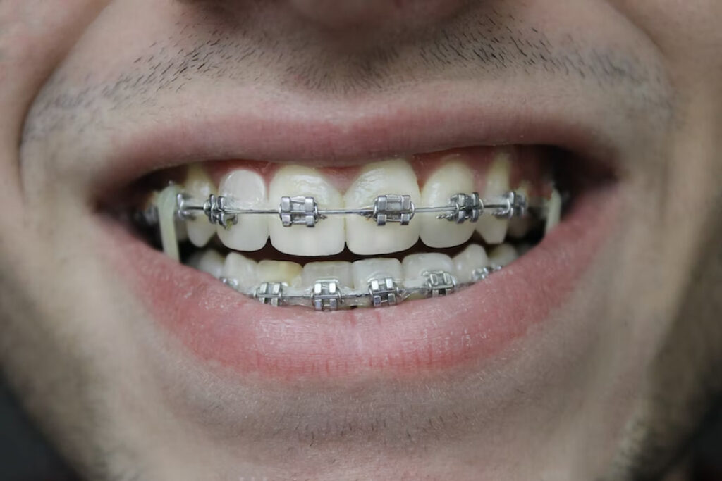 closeup of person's mouth and teeth with braces