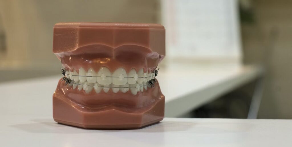 braces on teeth model