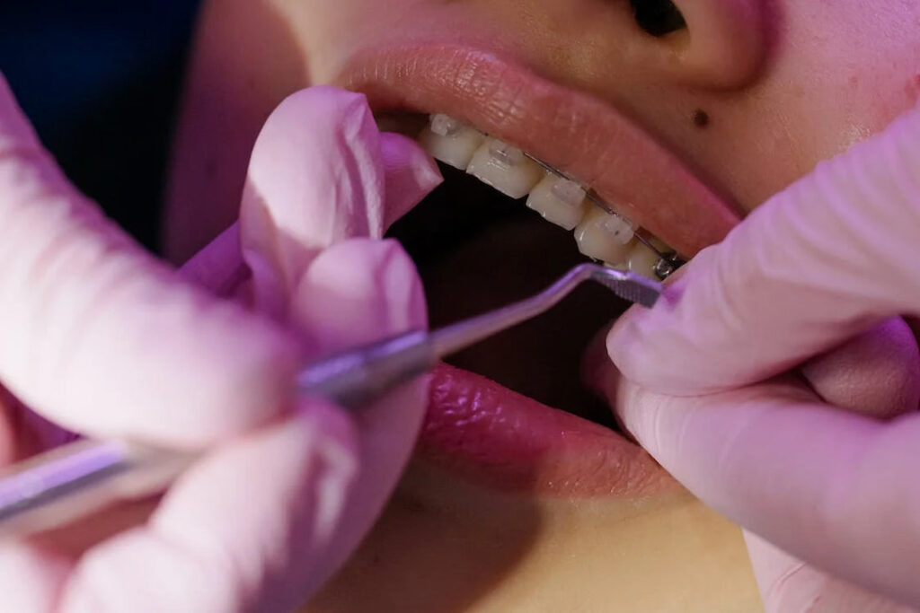 a dentist setting the braces on person's teeth