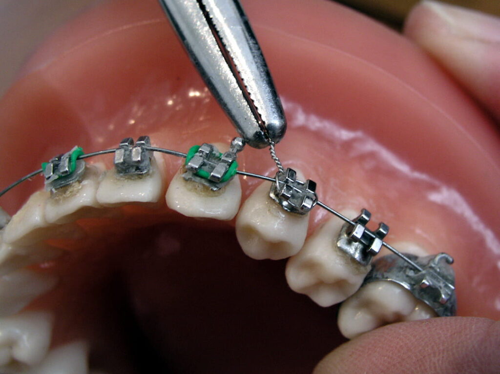 adjusting the braces