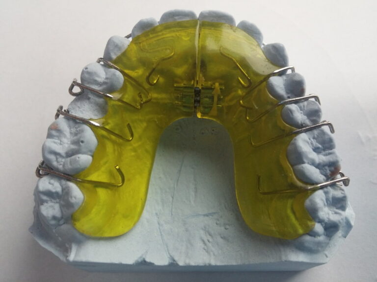 What Does a Retainer Do? OC Dental Center
