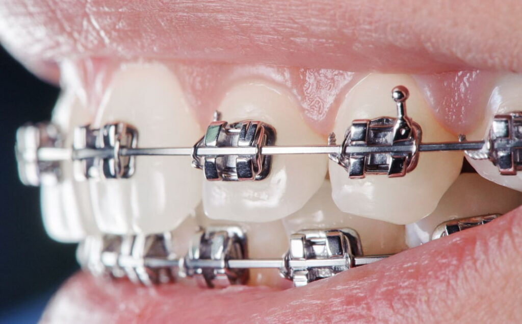 closeup of braces on person's teeth