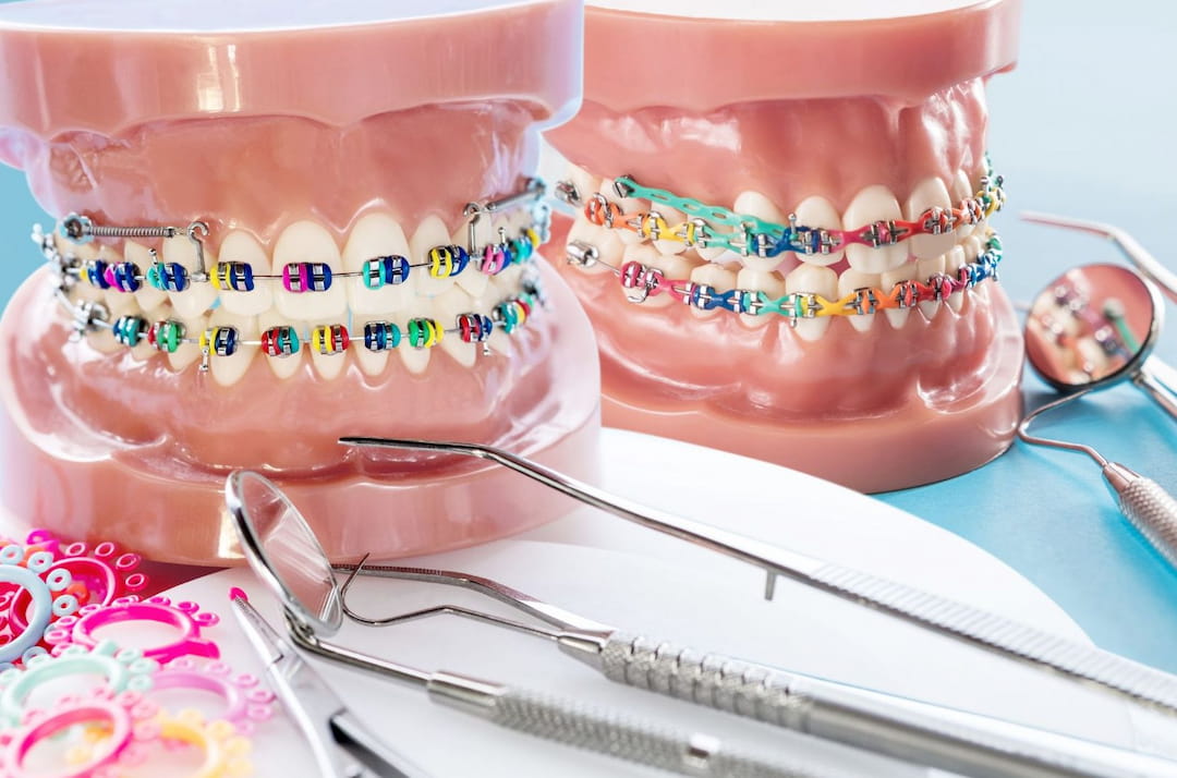 braces with various colors rubbers