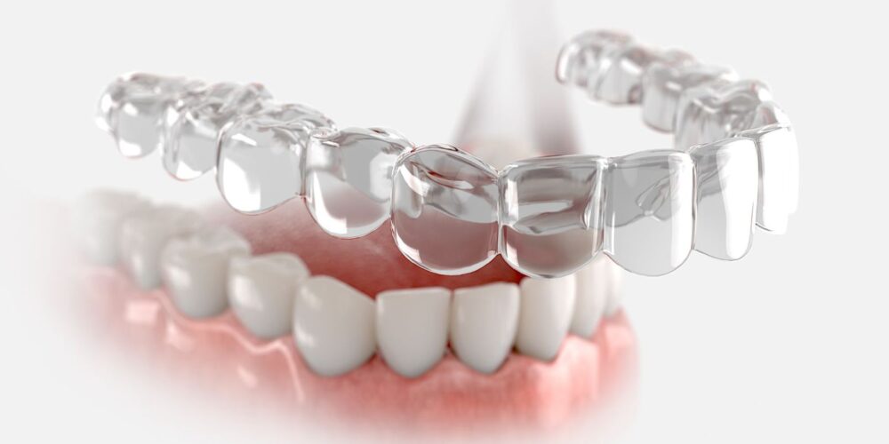 How Long Do You Have to Wear a Retainer? OC Dental Center