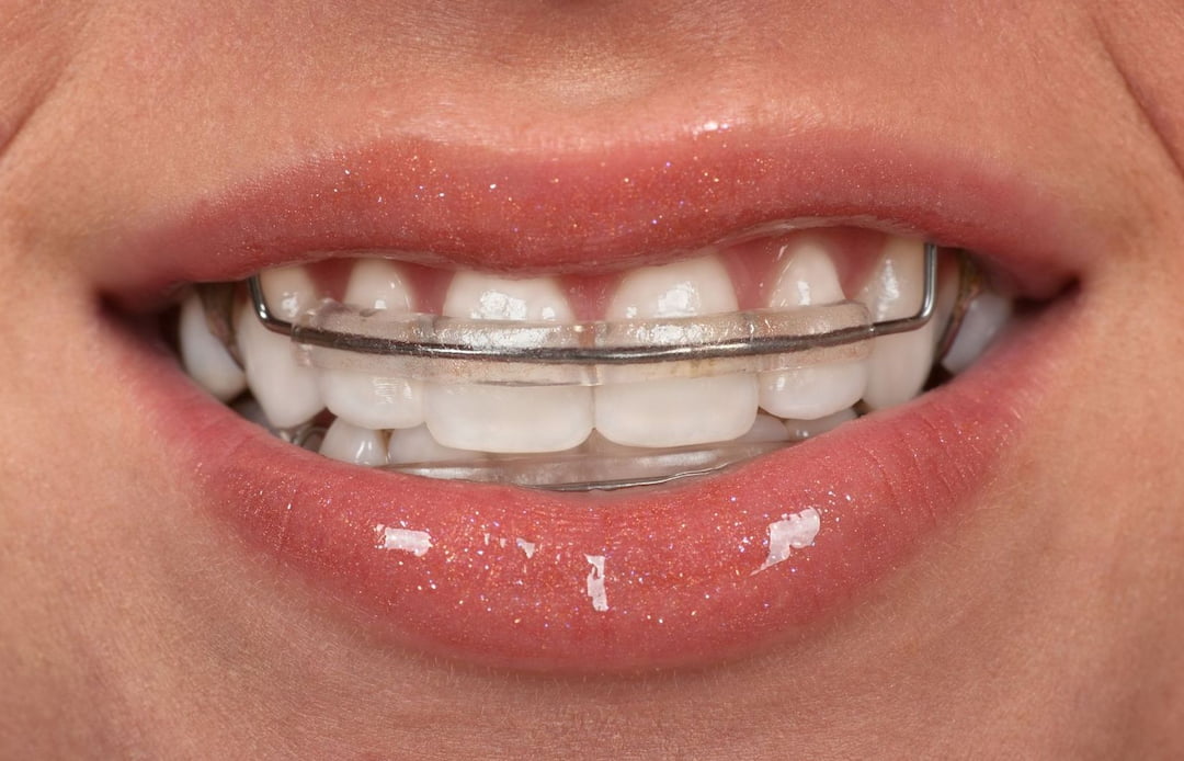 closeup of person's mouth and teeth with a retainer