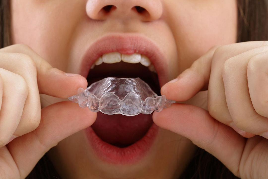 How Long Do You Have to Wear a Retainer? OC Dental Center