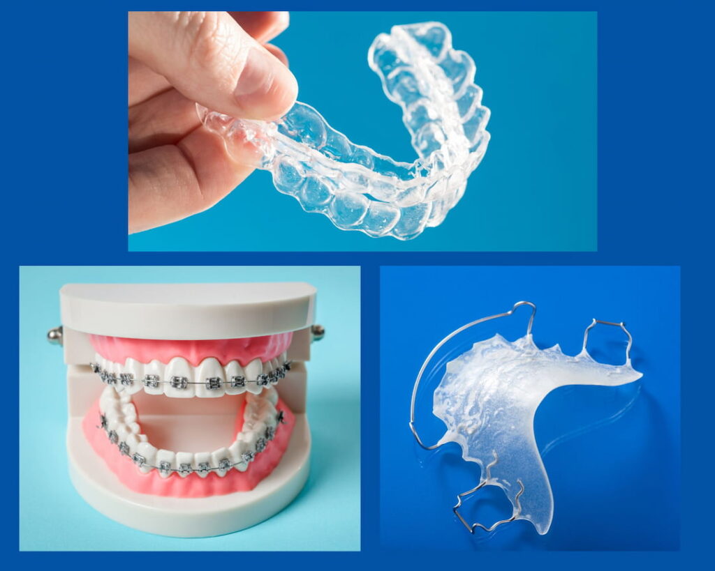 3 various types of retainers