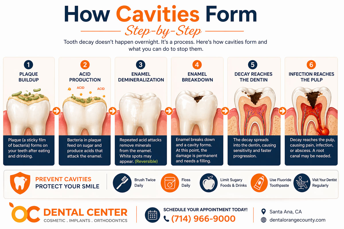 How Cavities Form Step by Step | Tooth Decay Process Santa Ana
