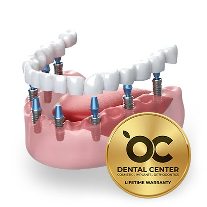 Dental implant lifetime warranty package illustration