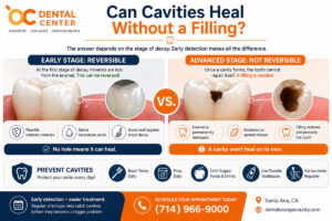 Can Cavities Heal Without a Filling | Tooth Decay Guide Santa Ana