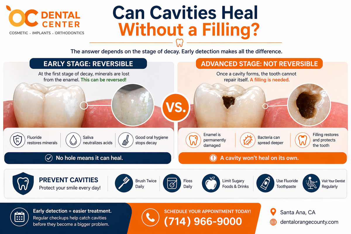 Can Cavities Heal Without a Filling | Tooth Decay Guide Santa Ana