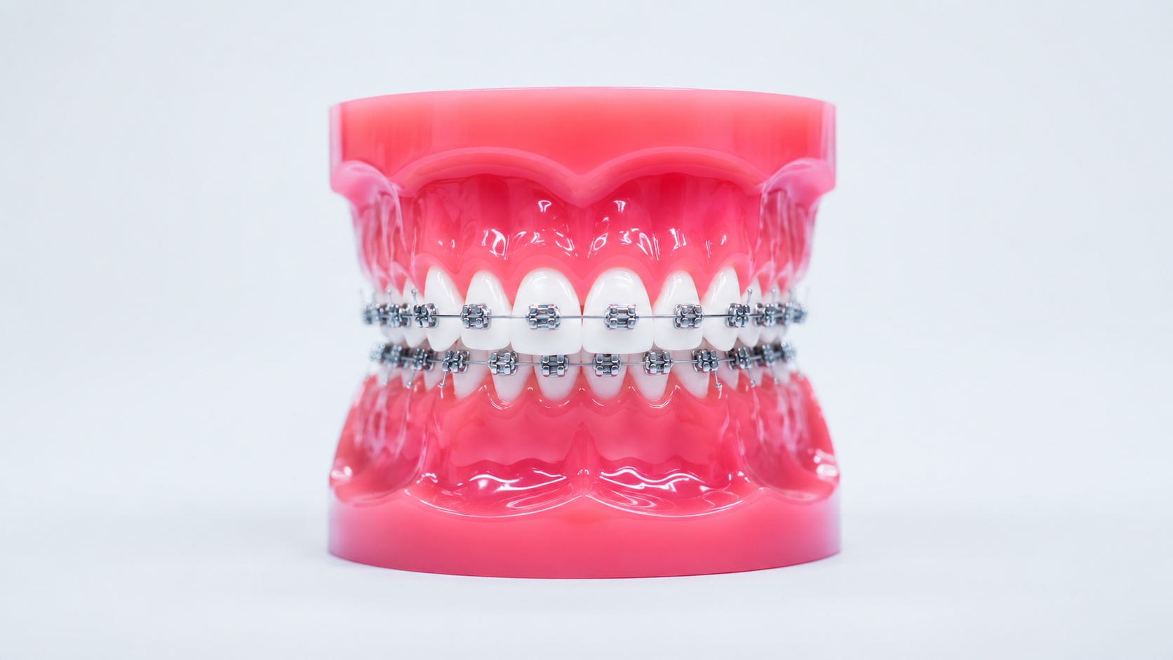 Close-up of a patient wearing traditional metal braces