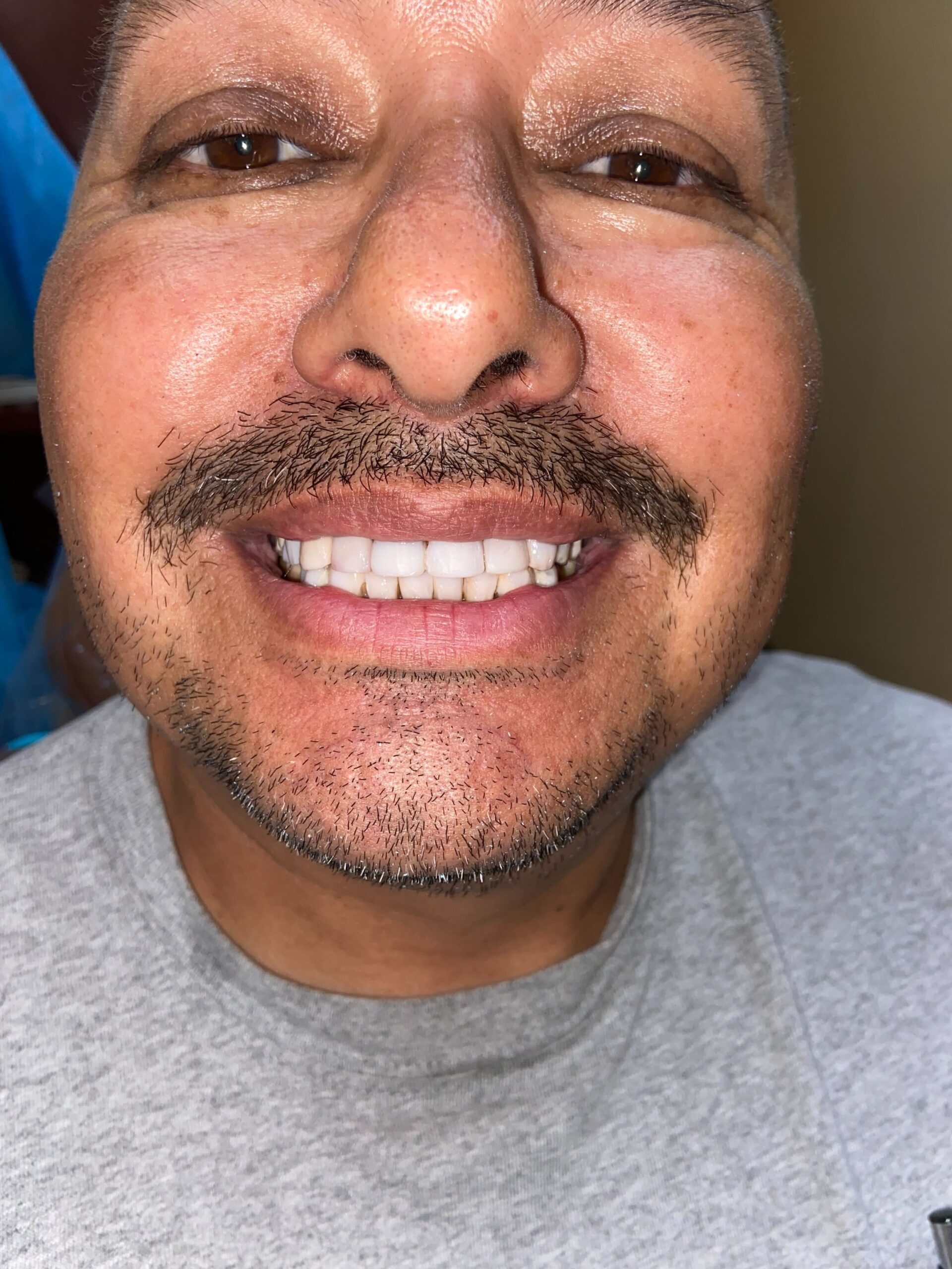 OC Dental Center patient smiling after veneer treatment