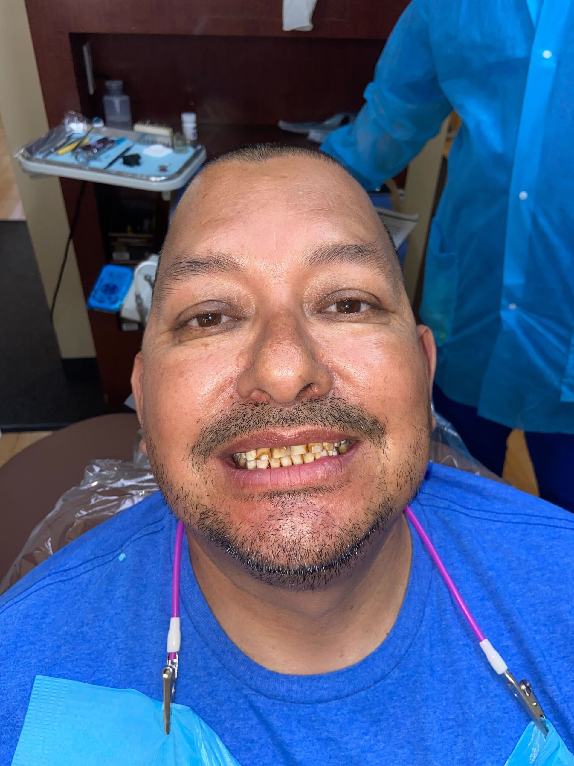The same patient before veneer treatment