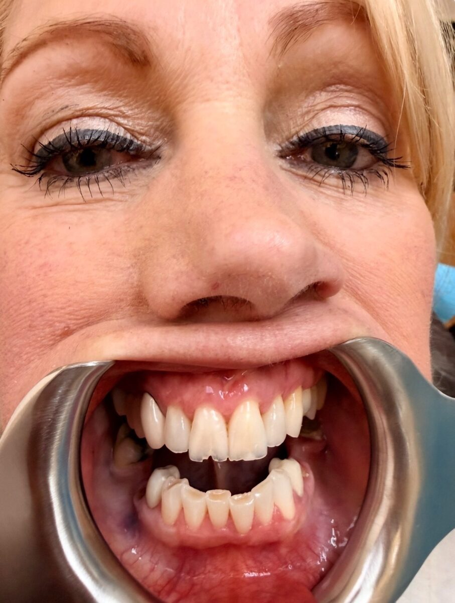 The same second patient before treatment, shown in a clinical dental photograph